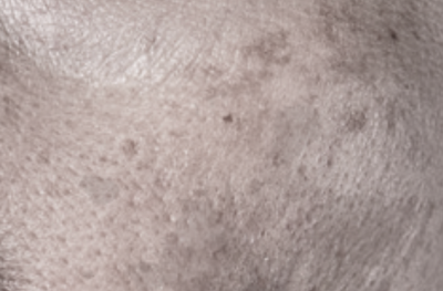 DARK SPOTS