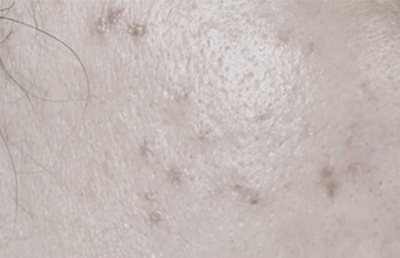 PIGMENTATION