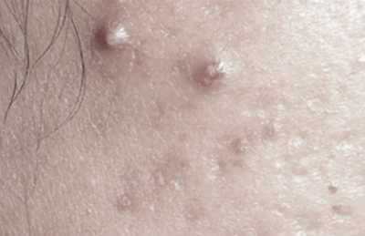 ACNE & PIMPLES